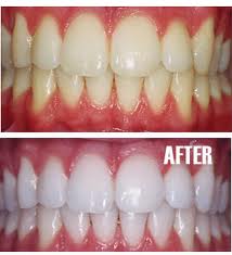 whitening